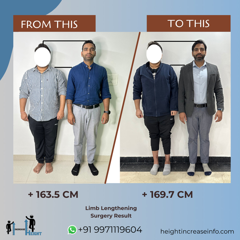 Limb Lengthening Result 1